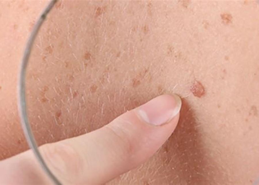 كيف تتجنب أحد أخطر أنواع سرطان الجلد؟